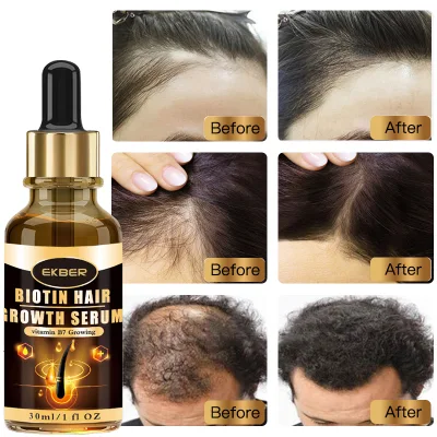 Hair Growth Serum for Men and Women Anti Loss Awaken Roots Repair Scalp for Hair Ginger Oil Biotin Serum