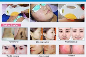 Lifting acne pigment ipl laser hair removal machine ipl laser hair removal ipl hair removal