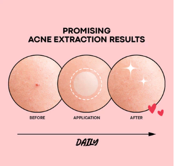 Pimple Clear Spot Patch 26 Patches(Treatment, Protects &amp; Covers Acne Scars, Transparent)