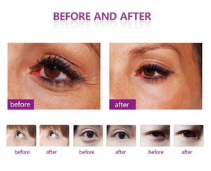 Special electric rf Eye Bags eye wrinkle remove/eye anti-wrinkle massage/ eye massage machine