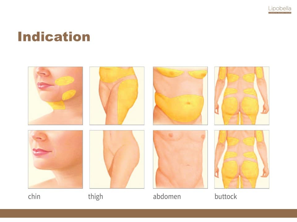 Lipobella Soluble Serum (fat desolve, fat burner, lipolysis)