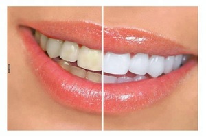 SH-66 hot blue led light teeth set tooth bright / tooth whitening kit / teeth whitening