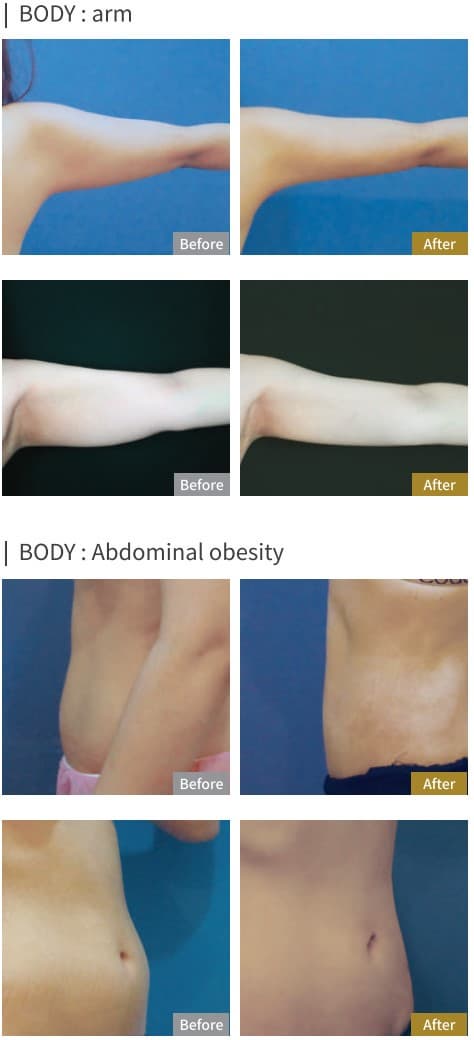 Lipo-line 5ml x 10ea
