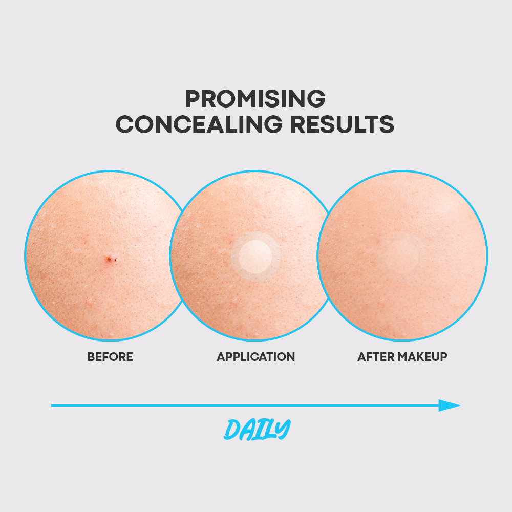 Pimple Patch Step 2 