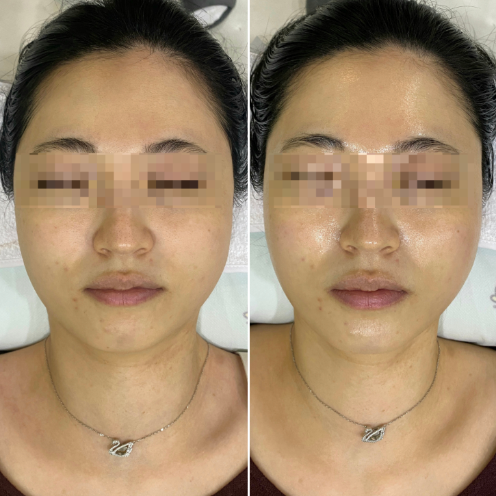 Portable Homecare HIFU Device "PENTHERMA"