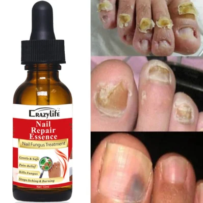 Spot Stock 10ml Effective Nail Repair Serum Essences Anti Fungus Remove Onychomycosis Toe Nourishing
