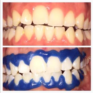 Super teeth whiten kit with teeth whiten gel/wholesale dental teeth whitening