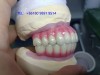 China Screw Retained Implant BridgeGood quality comes initial