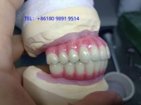 China Screw Retained Implant BridgeGood quality comes initial