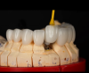 China Screw Retained Implant BridgeGood quality comes initial