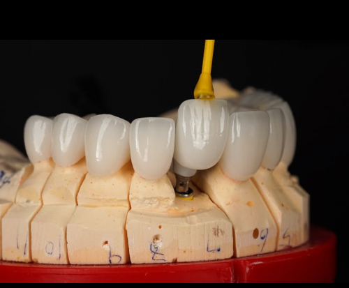 China Screw Retained Implant BridgeGood quality comes initial