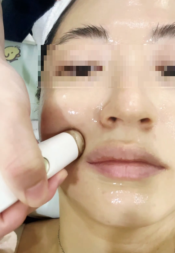 Portable Homecare HIFU Device "PENTHERMA"