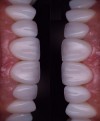 Emax Dental Crowns | China Zirconia Crowns Supplier