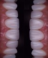 Emax Dental Crowns | China Zirconia Crowns Supplier