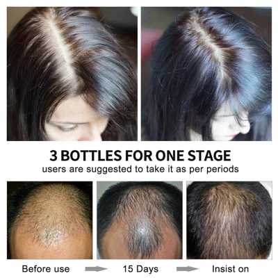 Wholesale Ekber Popular Tea Tree Biotin Hair Growth Serum 30ml Conservation Hair Follicle Hair Care Products
