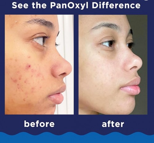 PanOxyl Acne Foaming Wash Benzoyl