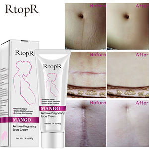 RtopR Natural Herbal Mango Anti Scar Cream Anti Wrinkle Maternity Repair Firming Fast Effective Anti Stretch Marks Cream