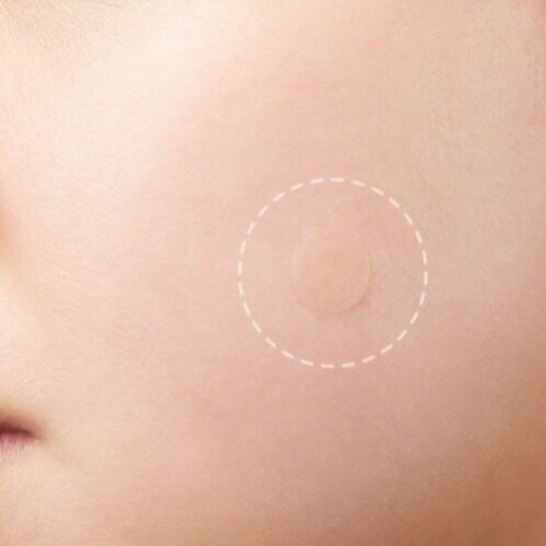 2020 Portablel Acne Remover Patch / Acne Remover Patch