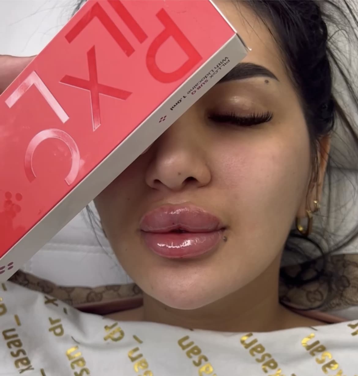 PILLOX HA Dermal Filler with CE