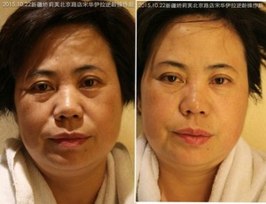Salon professional Face anti-wrinkle ultrasonic hifu machine MSLHF02 for sale