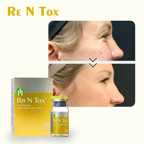 Botulax Botuliums Meditoxins Nabotas Wrinkle Removal Injection Toxin