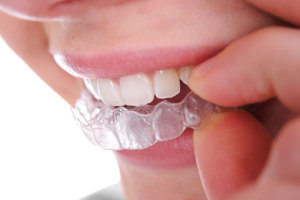 Teeth whiteningThermoforming mouth piece/Teeth Whitening Mouth guard