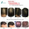 Anti Hair Loss Laser 650nm Diode Hair Regrowth Laser Machine for Hair Clinic /SPA /Salon