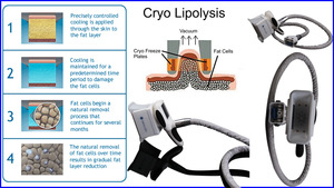 Tummy esthetics equipment professional lipo laser machine liposuction laser treatment