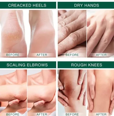 Wholesale Hand and Foot Care Whitening Repair Moisturizing Peel Crack 42% Urea Foot Cream Private Label