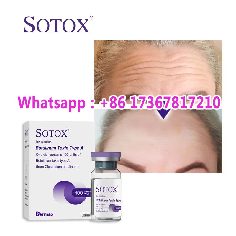 Sotox High Purity Facial Anti-Wrinkle Botulinum Toxin Type A for Injection