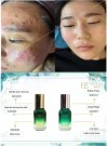Fade Acne Scars,Gentle acne removal,Deep Repair