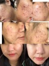 Fade Acne Scars,Gentle acne removal,Deep Repair