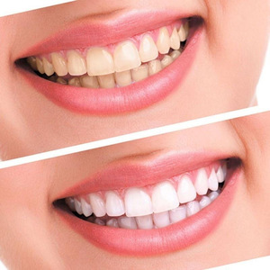 Teeth Whitening Dry Strips Need 3D Whitestrips , High Quality Teeth White Dry Strips