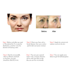 YYR Dropshipping Microneedling Face Body Skin Care 540 needles Derma Roller