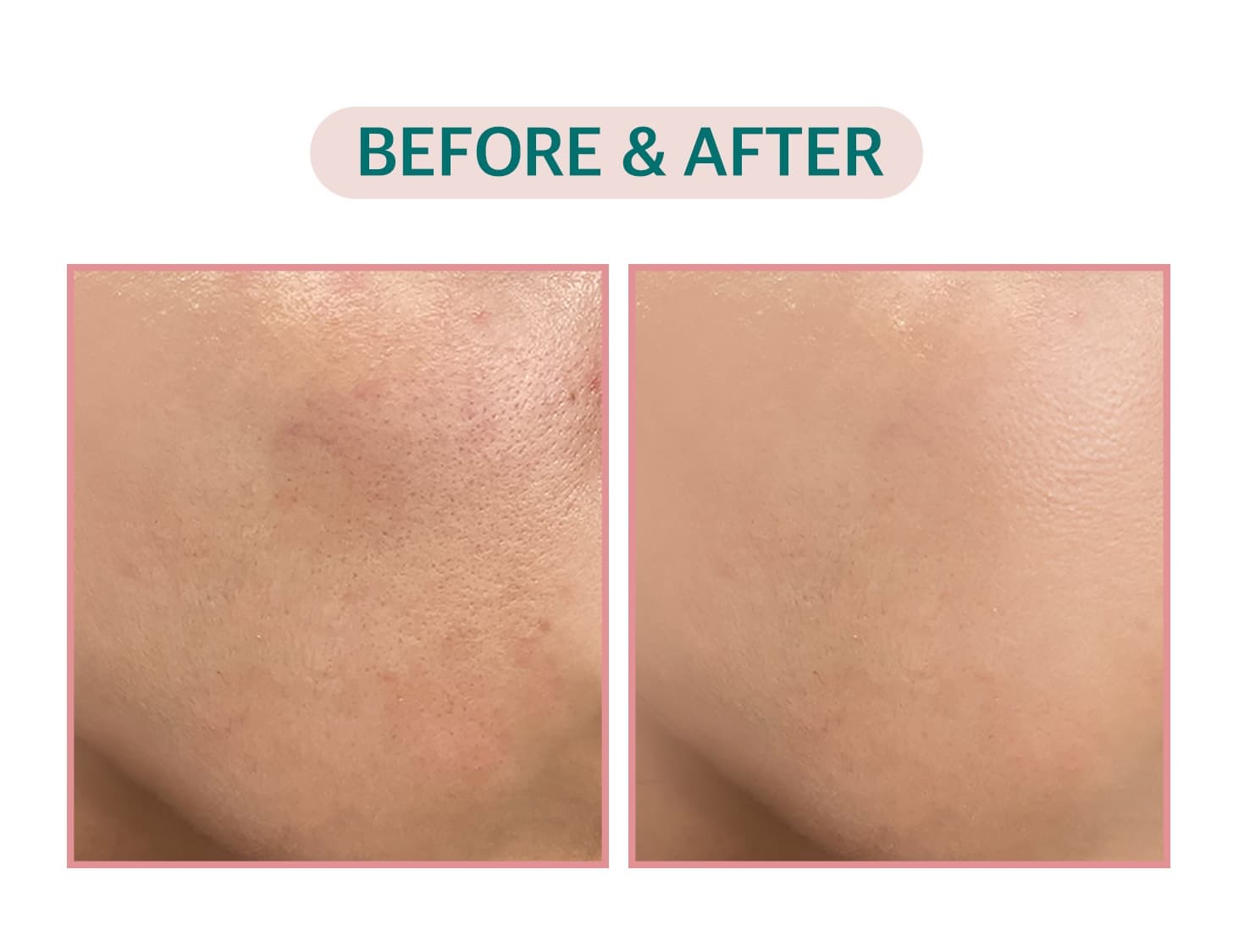 VEGAN Skin Care Slightly Acidic Tea Tree &amp; Cica-80 Pore Tightening Ampoule 30ml