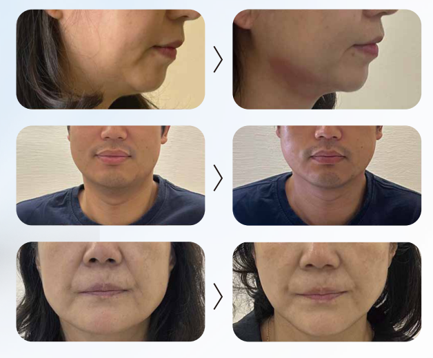 WAYBALM Beauty - Focused Shockwave Facial Lifting Device