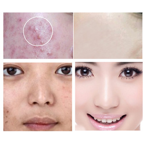 Acne Removal Rejuvenation & Cream