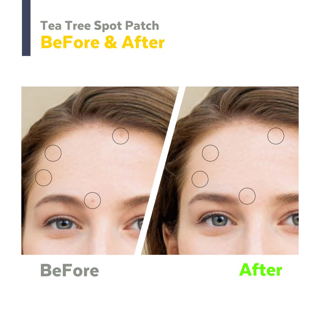 Hellocell Tea Tree Spot patch - Acne, pimple patch