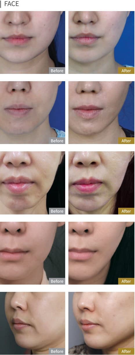 Lipo-line 5ml x 10ea