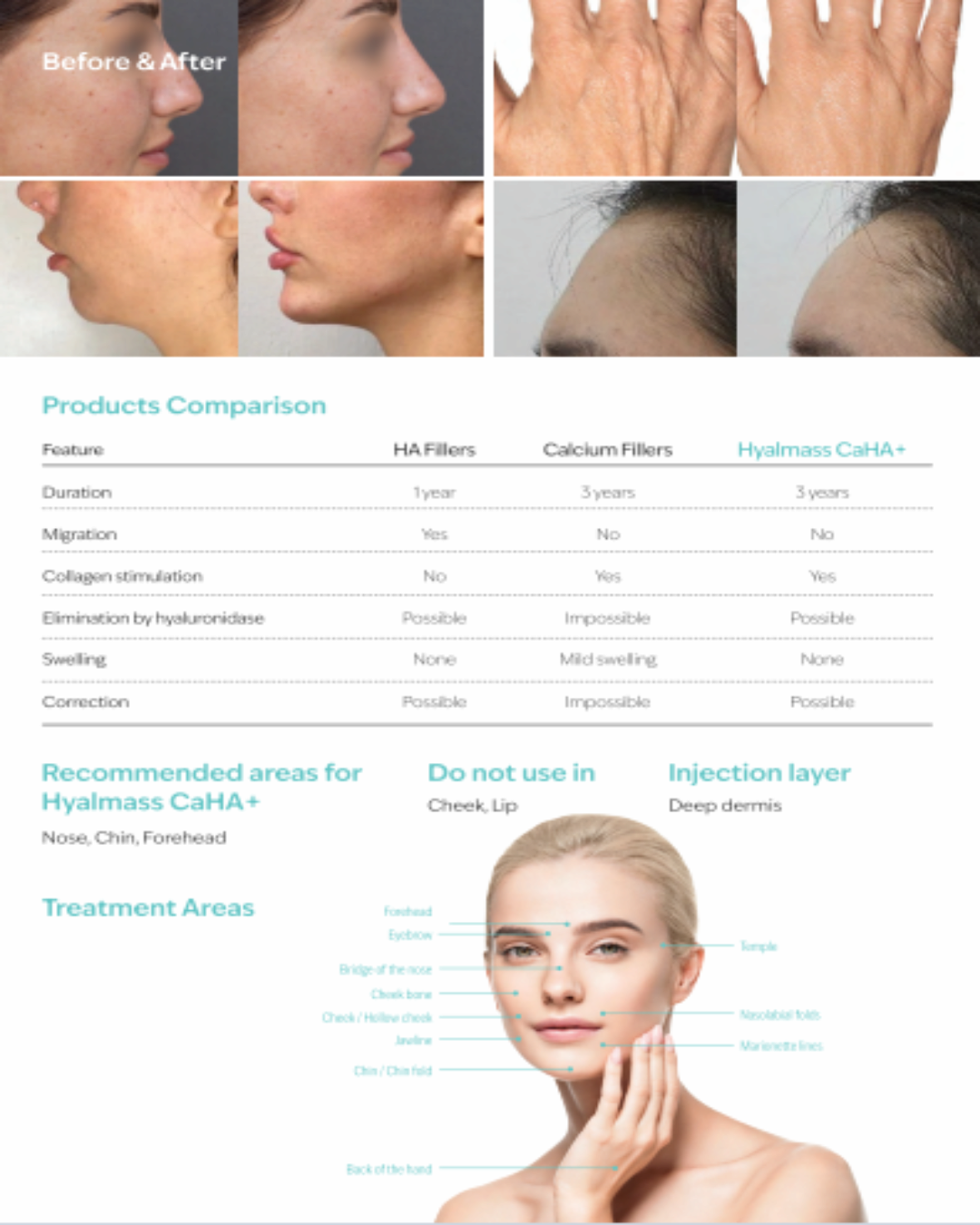 Hyalmass CaHA+ – Calcium Hydroxyapatite &amp; Hyaluronic Acid Filler