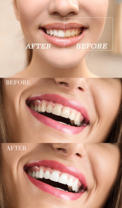 3Pcs Teeth Whitening Gel Carbamide Peroxide Gel Teeth Whitener Dental Bleaching Tooth Syringe Gel