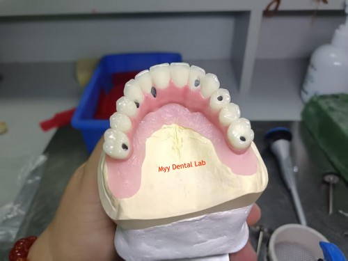 Myy Denture Implant Lab --- Screw-Retained Dentures - Myy  Denture Implant Lab