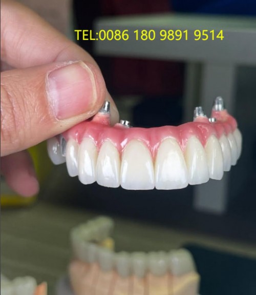 Myy Denture Implant Lab --- Screw-Retained Dentures - Myy  Denture Implant Lab