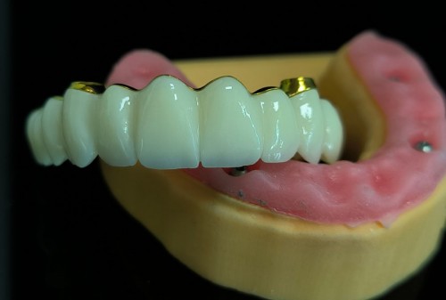 Myy Denture Implant Lab --- Screw-Retained Dentures - Myy  Denture Implant Lab