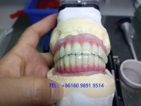 Myy Denture Implant Lab --- Screw-Retained Dentures - Myy  Denture Implant Lab