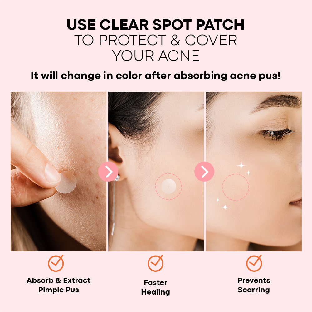 Acne Pimple Patch Hydrocolloid
